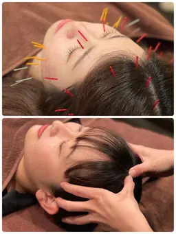 『🎁12月限定🎄』美容鍼＋小顔施術　美容鍼と小顔施術を同時に行うことで効果倍増‼︎