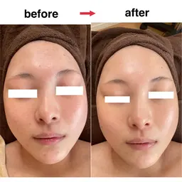 人気No.2✨ハーブピーリング🌿80分//ビタミンCまたはヒアルロン酸導入付き/デコルテマッサージ付き