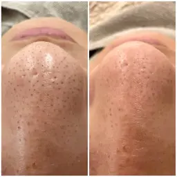 予約殺到★【詰まり・ざらつき撃退】毛穴洗浄（全顔）¥6,600→¥5,500