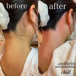 ✨【MIX脱毛うなじ✨】