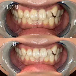 🎍新春記念🎍【セルフホワイトニング|20分照射】歯を白くして笑顔に自信を✨¥2880→\¥2480/