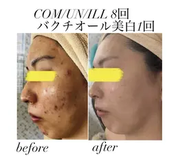 徹底ニキビケア✴️クリスティーナコモデックス✴️トラブル解消＆再発防止