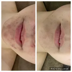 ★モデルニコルちゃんやみちょぱも絶賛♪大人気剥離なしハーブピーリング★様々なトラブルから開放！一気に肌再生♪