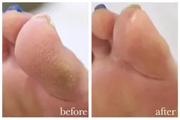 足の裏の角質除去・爪のケアや爪切り・魚の目の除去・タコの除去など、相談の上メニューの決定