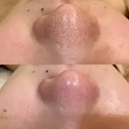 【モニター募集!】毛穴洗浄45分コース(鼻のみ)