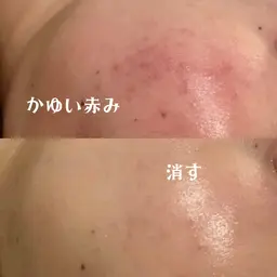 【13日限定❤️❕】ニキビ/ニキビ跡/毛穴/乾燥などが気になる方⭐️3300円‼️