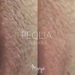 【最新メラニンケア/Mipyu】VIゾーン/アフタークリーム1ヶ月分付