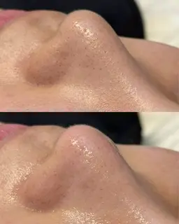 【先着10名】つるん♡毛穴スッキリmenu🫧