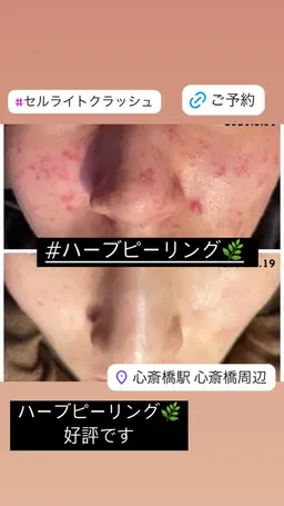 🌿国産ハーブピーリング🌿　1部位選んで！！