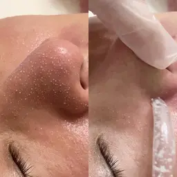 韓国式3D毛穴洗浄