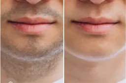 【メンズ】【WAX脱毛】口周り