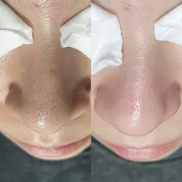 【技術向上練習モデル】毛穴の黒ずみ！角栓！スッキリ✨️話題の毛穴改善エステ！