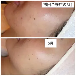 ピーリングでお肌を整えることからスタート💆‍♀️むくみ撃退、つや肌美容液導入🫧/80分コース