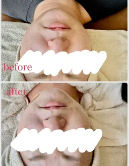 モニター募集！！筋膜リリースでリフトアップ、小顔に！！ほうれい線にも！！