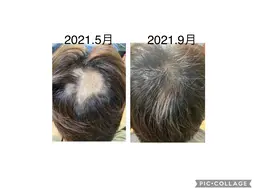 初回限定✨強髪プログラム（ヒト肝細胞培養液）を使用した頭皮ケア