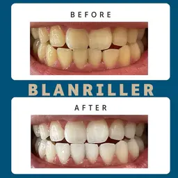 まずはお試し🎶大人気✨15分×2回セルフホワイトニング 3000円❤️ご新規様という利用条件のみ‼口コミ投稿等は不要✨