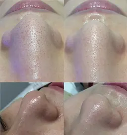 【毛穴洗浄】高濃度水素を試したい方必見☆イチゴ鼻ザラつき黒ずみ皮脂に◎