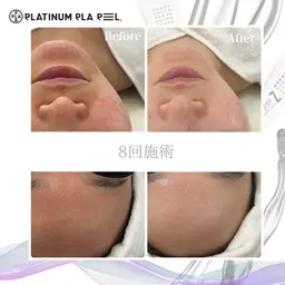 🩵艶美白 プラチナピール🩵《美白ケア・ニキビケア・黒ずみ毛穴ケア・シワたるみケア・エイジングケア・乾燥ケア》パック付