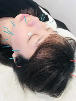 肌荒れ・リフトアップ⭐️美容鍼のみ