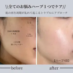 【ハーブピーリング】お肌の土台のケアです♪ニキビ/ニキビ跡/たるみ/シミが気になる方へ