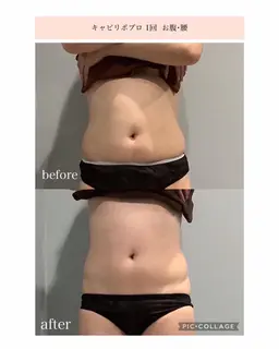 【半身スリム】上or下半身 (キャビテーション/ラジオ波/吸引/EMS) 結果重視最強マシン