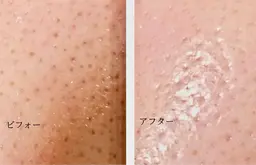 《ごっそり毛穴洗浄💗》角質ピーリング+ハイドラ洗浄+美容液