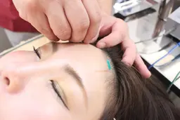 【日曜限定】モニター募集（美容鍼＆光エステ）※毎月先着１名