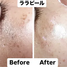 【艶肌リフトUP💎】ララピール《顔＋首》＋デコルテリンパ＋プレミアムゲルLDM導入＋ヒト幹細胞パック