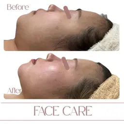 [ミニモ学割]U24限定‪‪❤︎‬フェイシャルハイパーナイフ40分‪‪❤︎‬デコルテ​〜​顔全体