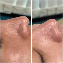 【お肌の悩み一つで解決❣️】光フェイシャル✨