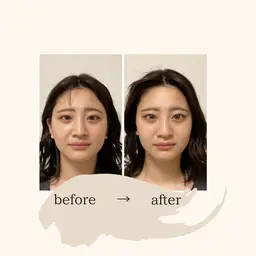 2回目以降の方　　　　　　　　　　　　　　　　　　　🌼美容鍼トータルケアコース🌼月2回コース