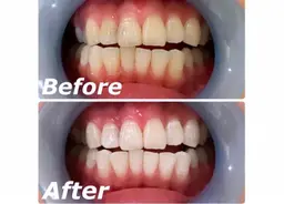 1ヶ月集中ケア🦷✨セルフホワイトニング