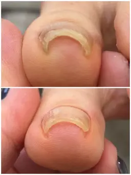 ☘️巻き爪ケアモデル☘️