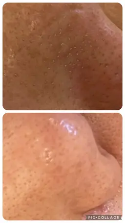 水素毛穴洗浄and小鼻むくみケア