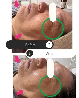 つるもちハーブピーリング剥離有り・無し選べます✨通常¥22,000円→初回体験¥9,800円