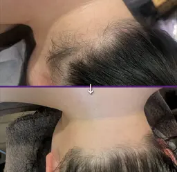 【レディース】うなじブラジリアンWax脱毛★ デザイン脱毛可能 ￥7800