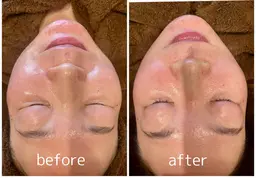 韓国発　ラピエラピーリング（小顔エステ付）