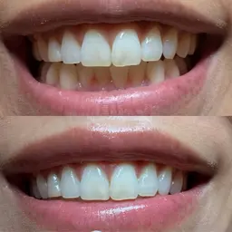 美歯口🦷セルフホワイトニング🦷(サポート付き)お得な回数券あり✨スタッフがきちんとサポートしながら受けられます✨