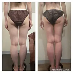モデル様募集🌿ハイパーナイフ✖️強力デトックスマッサージ🔥下半身集中⭐️脚痩せ&ヒップアップ