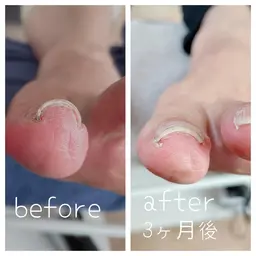 BSブレイス  巻き爪ケア（親指1本の施術料金になります。）