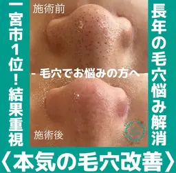 【SNSで話題結果重視！】最高峰の毛穴ケア🫧毛穴エクストラクション❤️‍🔥幹細胞パックプレゼント🎁