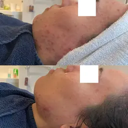 最新オリジナルハーブピーリング＋ヒアルロン酸導入(メンズも大歓迎)