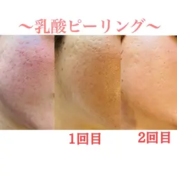 【ニキビ/毛穴でお悩みの方へ】ニキビケア＆艶肌に◎乳酸ピーリング（お肌タイプ別生コラーゲンマスクでコラーゲンチャージ！）