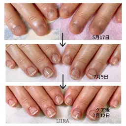 アトピー肌(爪)、小さい爪、噛み癖、いじり癖、肌荒れなど肌や爪の悩み事が相談室🖐️💅🌈🍀🌝