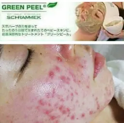 グリーンピール★スペシャル1day(ハーブトリートメント)初回割