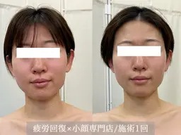 クイックコルギ＋顔脱毛(70分)