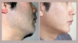 🌼メンズ専用🌼効果抜群！！ひげ脱毛☘️