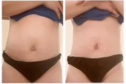 LDM 痩身　（希望部位）　サイズ　引き締め　ストレッチマーク対応◎