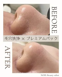 鼻スッキリ美肌コース🫧毛穴洗浄（鼻のみ）＋美容液導入＋引き締めパック✨
