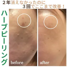【ニキビ】剥離なしハーブピーリング+美容液導入　50分